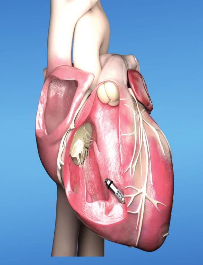 Willis-Knighton first in N. Louisiana implant Micra AV Pacemaker, world’s smallest